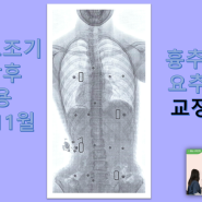 측만증 진단시 16세, 남자, 역S자형, 현재 2년 반 동안 척추측만증 보조기 착용中