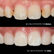 부산치아교정 VS 라미네이트 장단점 비교