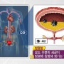 방광염 자연 치료 치유 방법과 생활 속 관리법