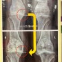 무릎 연골재생 수술없이 제대로!! 골관절염 치료기 닥터88 발견했어요