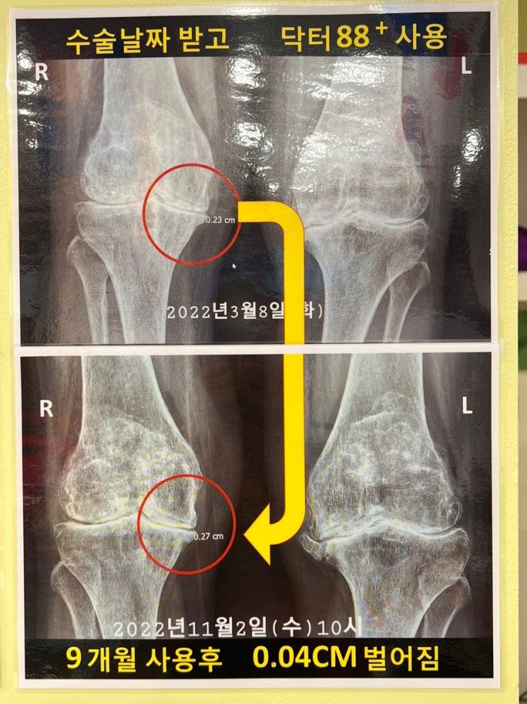 무릎 연골재생 수술없이 제대로!! 골관절염 치료기 닥터88 발견했어요 : 네이버 블로그