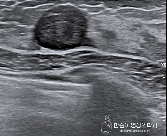 오른쪽 가슴 멍울 유방암인지 빨리 확인하는 방법 : 네이버 블로그
