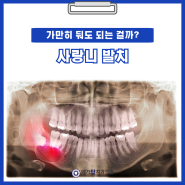 사랑니 발치 FAQ: 준비부터 회복까지 알아야 할 사항들