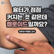 흉터가 점점 커지는 것 같은데 켈로이드일까요?