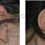 귀켈로이드 수술 사진 203