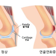 [부발 필라테스] 무릎 통증, 방치하지 마세요!