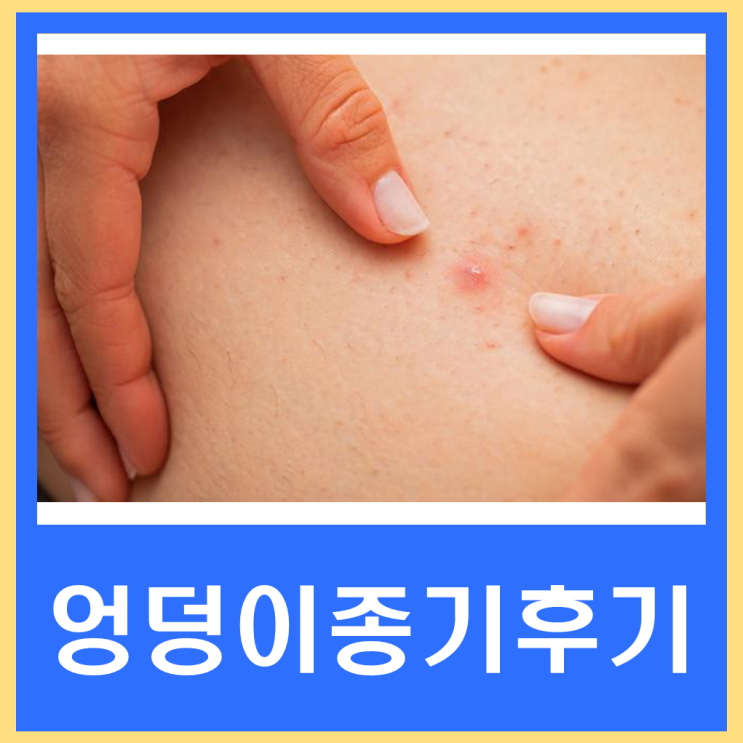 엉덩이 종기 재발 표피낭종 병원 수술 마취치료 후기 : 네이버 블로그