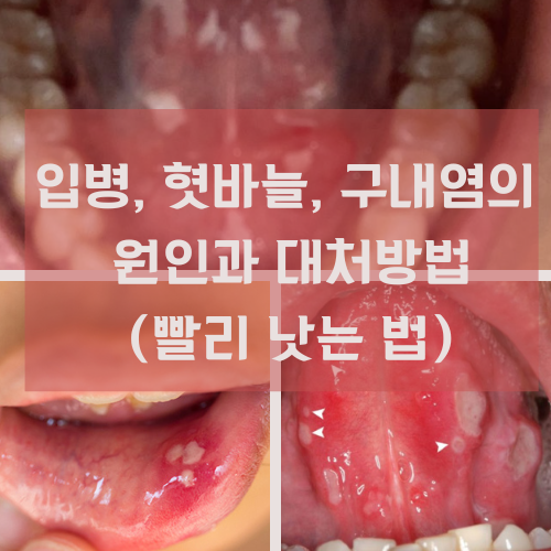 입병이 오래가요, 입병 생겼어요. 구내염 빨리 낫는 법과 원인, 증상 (혓바늘, 입병 , 입술염증,구내염) : 네이버 블로그