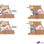 [이경원청각언어연구소] 고막형 보청기의 올바른 착용방법과 음질