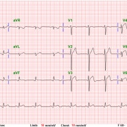 급성 흉통환자의 심전도