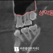 간석동 치과 매복된 윗니 사랑니 상악동 천공 없이 안전하게 발치하는 방법