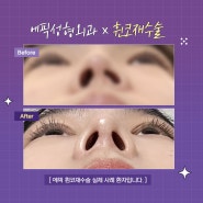 에픽 휜코재수술, 두 번의 실패는 없도록💜