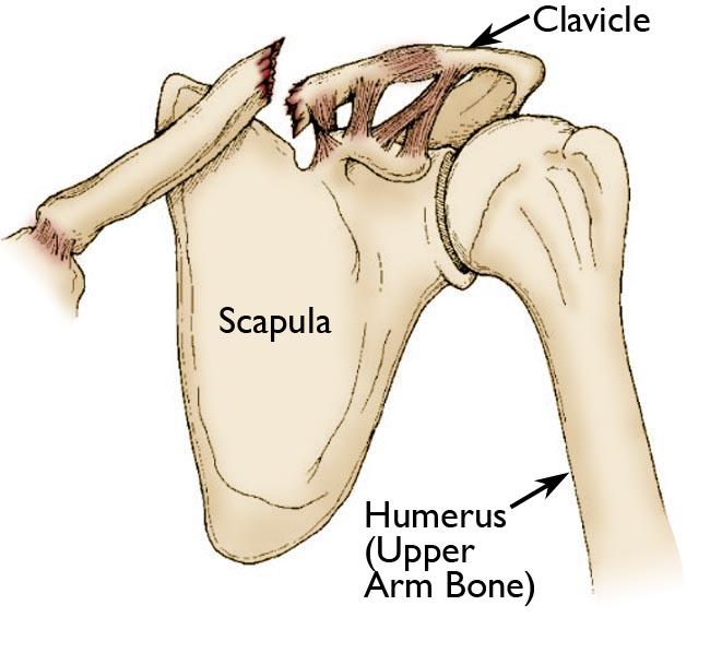 어깨 외상 traumatic conditions : 빗장뼈골절 (쇄골골절, clavicle fracture) : 네이버 블로그