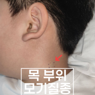 목 모기질종 핀홀법 수술 후기 [서울 분당 성남 강동구 송파구 잠실 강남구 광진구 하남 미사](수면마취 대학병원 전신마취)