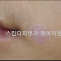 선천성 색소 세포성 모반(Congenital Melanocytic Nevus)의 치료 (옵티컬 채널링 Optical Channeling)