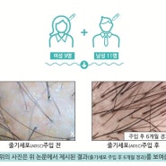 피할수 없는 탈모