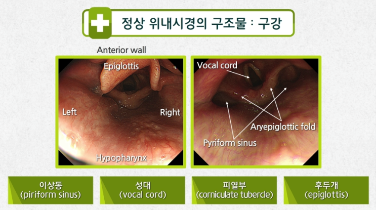 위내시경 (정상 구조물 및 병변기술) : 네이버 블로그