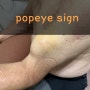 상완 이두근 장두 파열, 뽀빠이 사인(popeye sign)