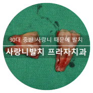 광교 수원 사랑니발치 치과 아래 매복 사랑니 때문에 인접 치아치근 흡수 치조골 흡수 발치