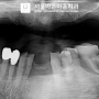 금천구 치과 브릿지와 임플란트 수술 통해 상실된 치아 회복해 드렸습니다.