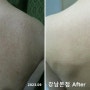 재발을 막아주는 등드름 치료 미강약침