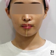 부산안면비대칭교정 한의원 에서 확실한 효과보고 있는 두번째 후기