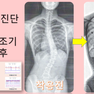 척추측만증 진단 부터 척추측만보조기 졸업을 하기까지 진행과정