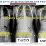 탑팀재활의학과에서 사용한 원남보조기, 야간(찰스턴)-수면형 측만증 보조기 호전 사례 24년 3분기