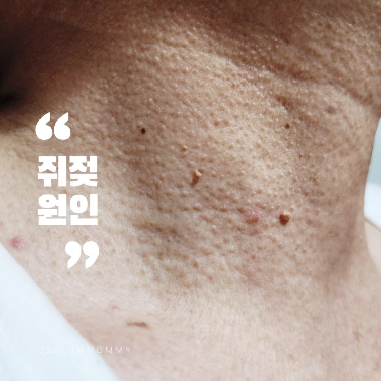 쥐젖원인, 당뇨쥐젖 및 쥐젖없애는법 : 네이버 블로그