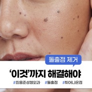 대구 돌출점 제거 수술 '이것'까지 해결해야 합니다.