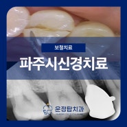 파주시신경치료 치아가 쪼개져서 아파요