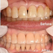 많은 치과들이 앞니지르코니아크라운으로 치료하는 이유