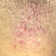 모낭염毛囊炎Folliculitis 포항한의원 오천읍 허한의원