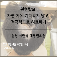 원형탈모, 스테로이드 치료만이 정답은 아니다, 지실치자시탕가미방 ; 분당탈모한의원 서현역원형탈모치료 수내동스트레스성탈모