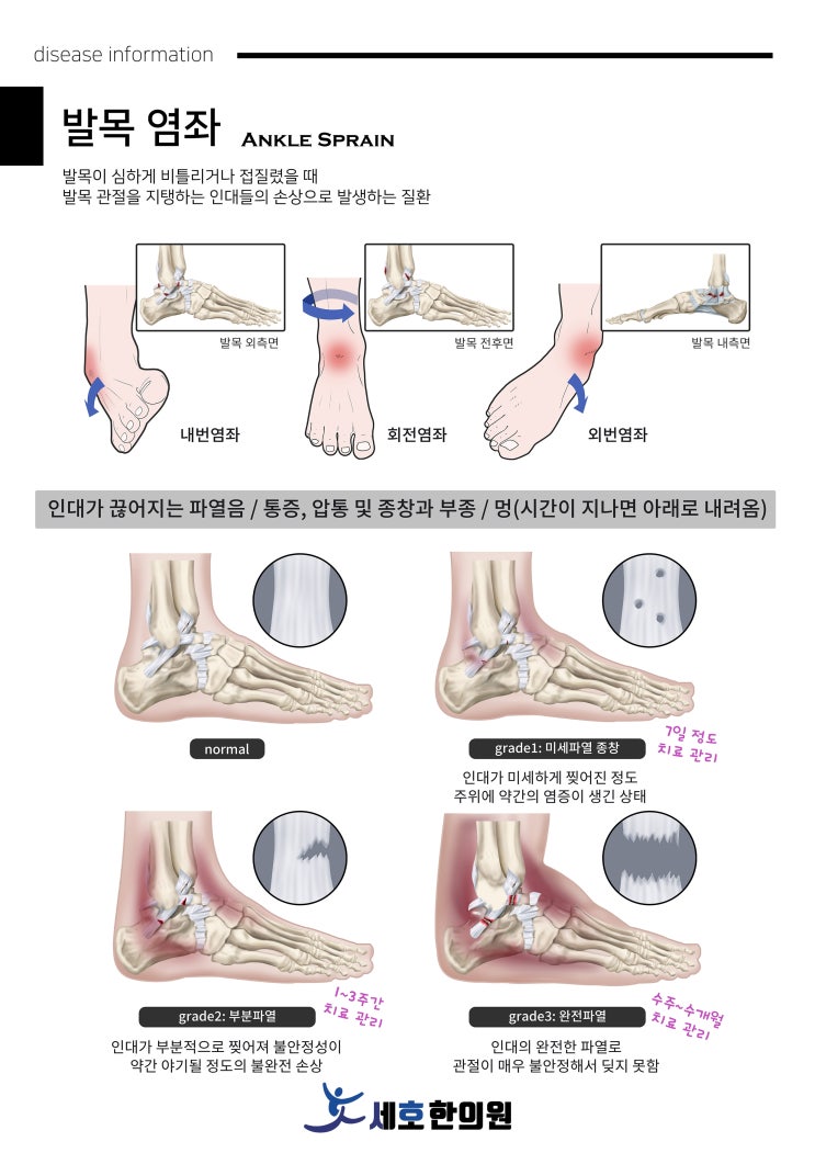 발목 염좌 원인 및 대처 방법과 치료 방법, 그리고 재활 운동 소개 (충남 당진 세호한의원) : 네이버 블로그