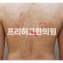 수원두드러기 유형과 증상에 맞는 치료