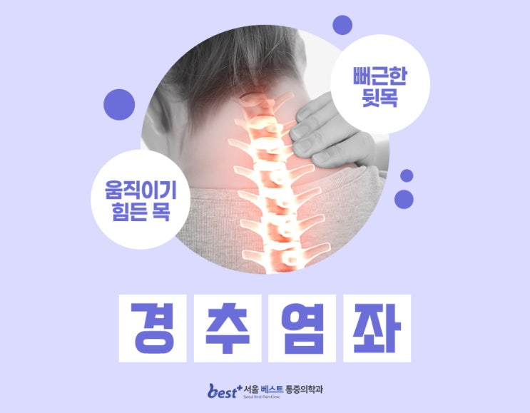 목에 담 걸린 듯한 통증? 경추염좌 주의! : 네이버 블로그