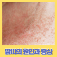 땀띠의 원인과 증상 치료방법과 예방방법