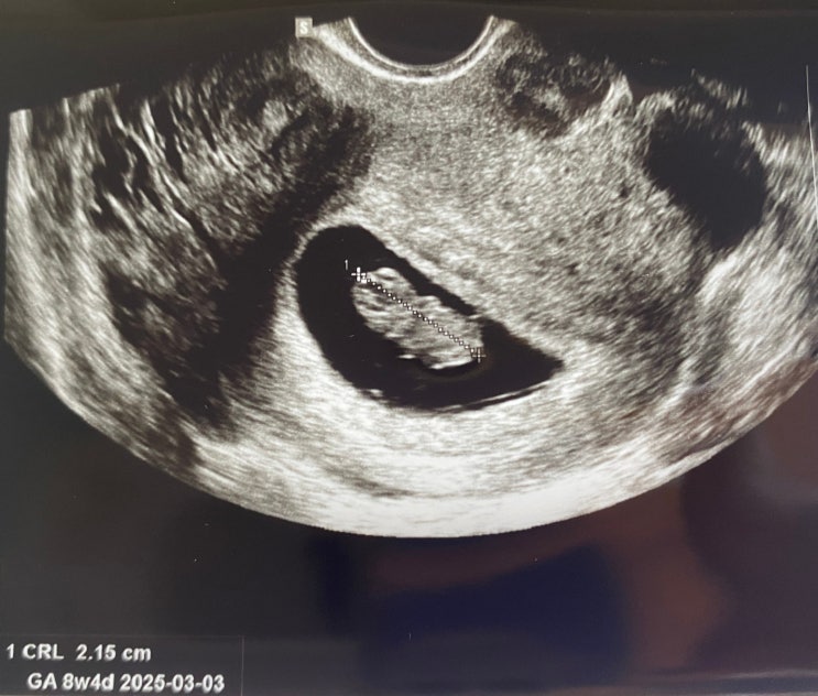 [2024.07.26] 산부인과 세번째 진료(feat. 젤리곰) 8주 4일 네이버 블로그