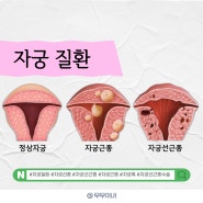 자궁선종 자궁선긍종 통증 수술 자궁근종 혹 질환 원인 증상