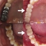 골다공증 임플란트 '약을 복용중인데 치료를 받을 수 있을까?' 발산역 치과