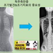 각도가 작을 때 척추측만증 보조기를 착용하여 세심하게 측만증을 방어중인 케이스- 원남메디칼(주) 원남보조기