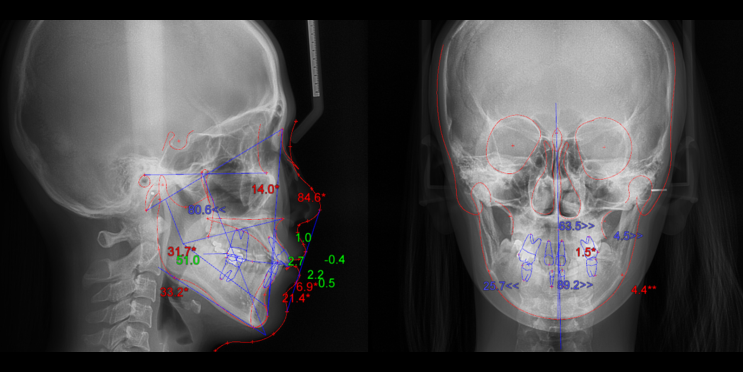 Cephalometric radiography : 네이버 블로그