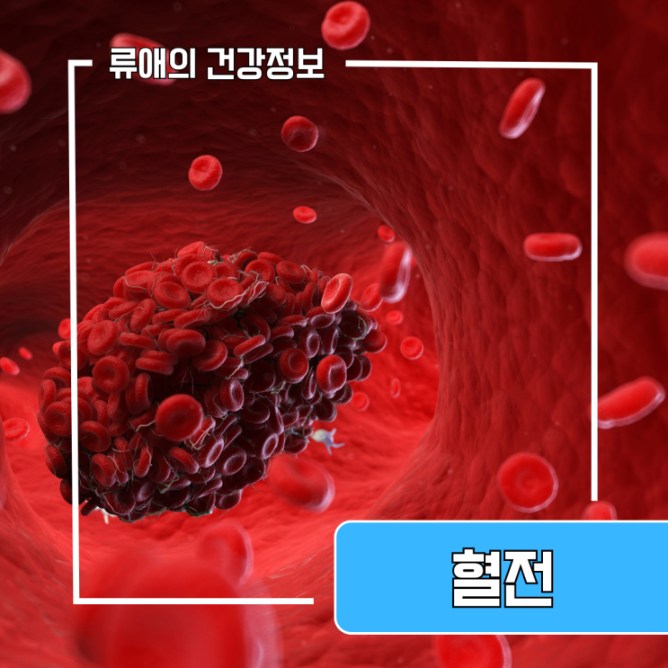혈전초기증상 및 치료 혈전 없애는법 녹이는 성분 : 네이버 블로그