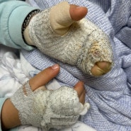 아기2도화상 양손화상 회복후기(상처사진O) : 화상전문병원 한림대학교 한강성심병원