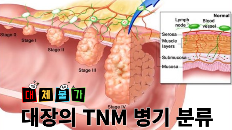대장암 TNM병기 TNM분류 애슬러-콜러병기 : 네이버 블로그