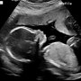 [임신일기] 18주~21주 미국 산부인과, 정밀 초음파 후기 🍼 노래추천
