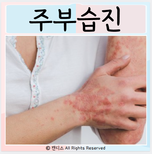 주부습진 피부습진 원인 증상 치료방법 : 네이버 블로그