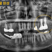 상악동 골이식 임플란트 수술 월곡역치과 서울바른닥터치과