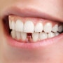 [논현역치과] 치아교정과 임플란트, 동시에 치료 가능할까?